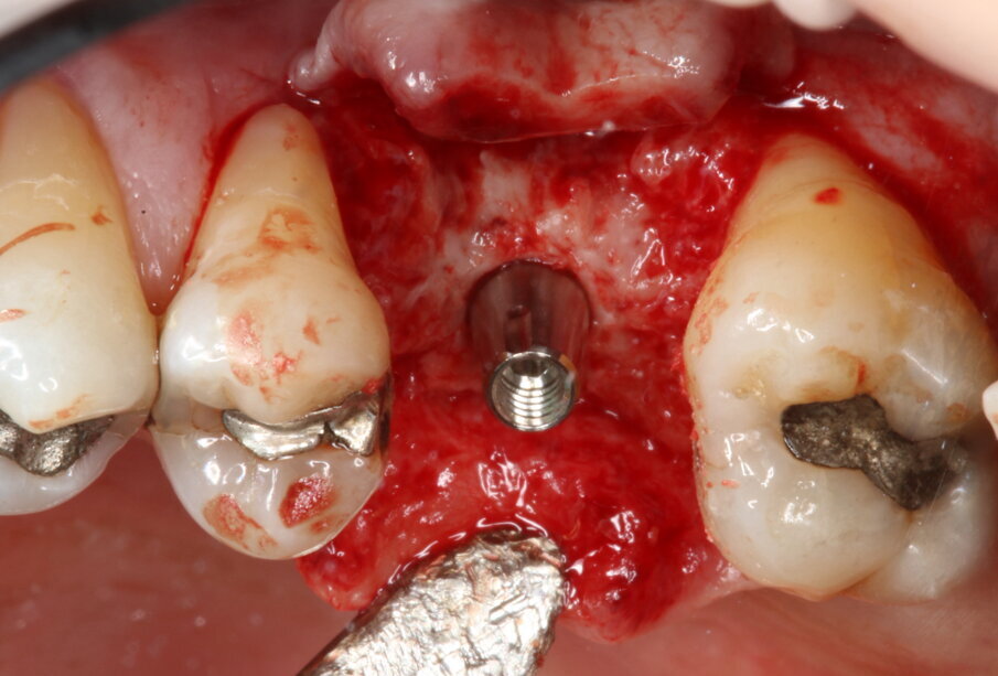 Fig. 5_Applicazione del moncone conometrico dritto.