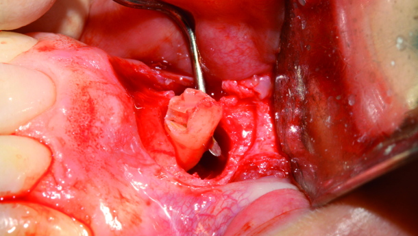 Supernumerary teeth: Diagnosis and treatment