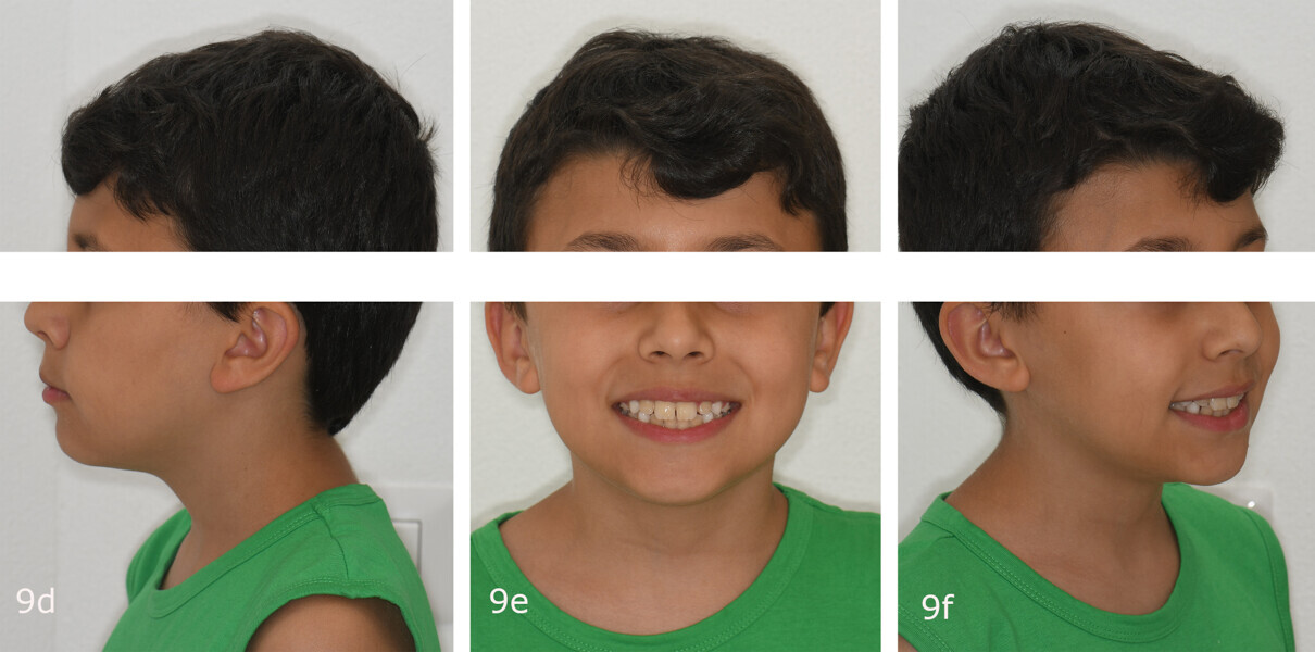 Figs. 9d–f: Comparison of the extra-oral photographs at the (a–c) start and (d–f) end of treatment.