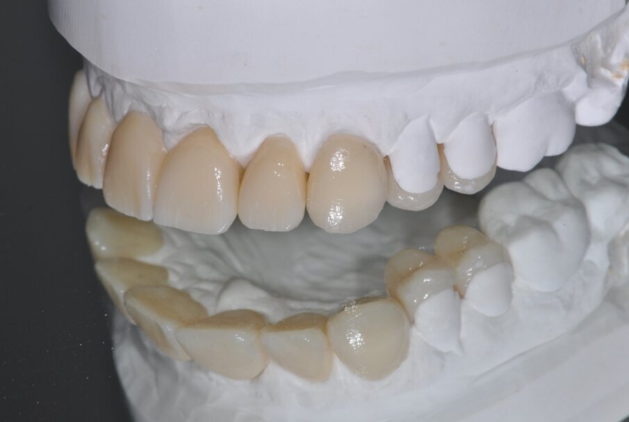 Fig. 12: Final customized restorations after staining and glaze firing