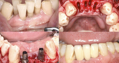 Factores clave en implantología