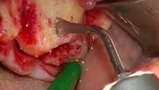 Piezochirurgie je metodou volby – rozhovor s Dr. Stavrosem Pelekanosem (Atény)