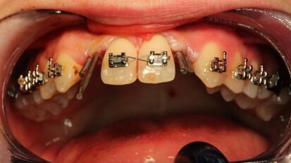 Wszczepy igłowe w hipodoncji siekaczy bocznych szczęki ze skrajnie cienkim wyrostkiem zębodołowym