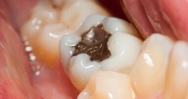 Debatte über Nutzung von Amalgam