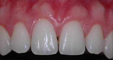 Процедури по удължаване на короните