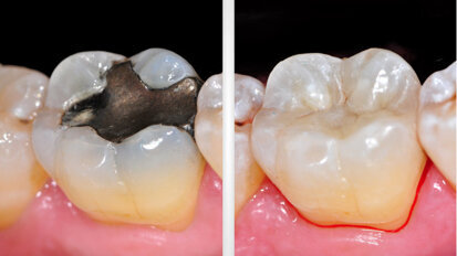 Effizienter Einsatz chromoadaptiver Komposite im Praxisalltag Effizienter Einsatz chromoadaptiver Komposite im Praxisalltag
