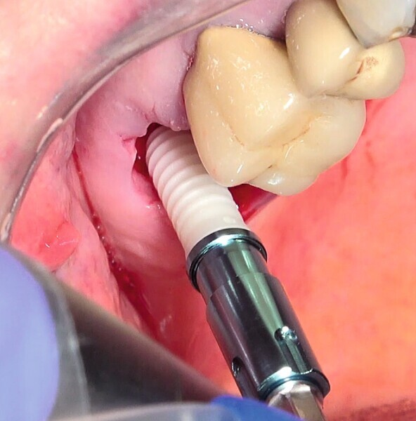 Fig. 51 : Pose de l’implant deux pièces en céramique.