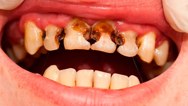 Individui con disturbi dei capelli possono essere più predisposti alla carie