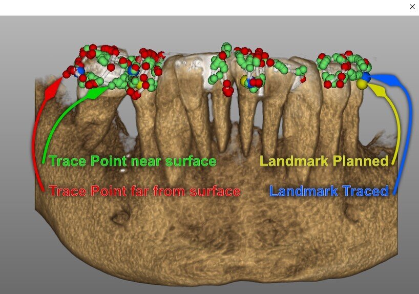 Figg. 7a, 7b - Valutazione della qualità della scansione per tastatura sulla base del confronto tra la posizione della punta del tracer rilevata ed i dati 3D della tac. a) Precisione della scansione; b) Legenda delle indicazioni in a.