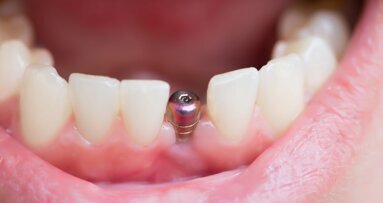 Researchers find that some periodontic residency programmes are reusing healing abutments