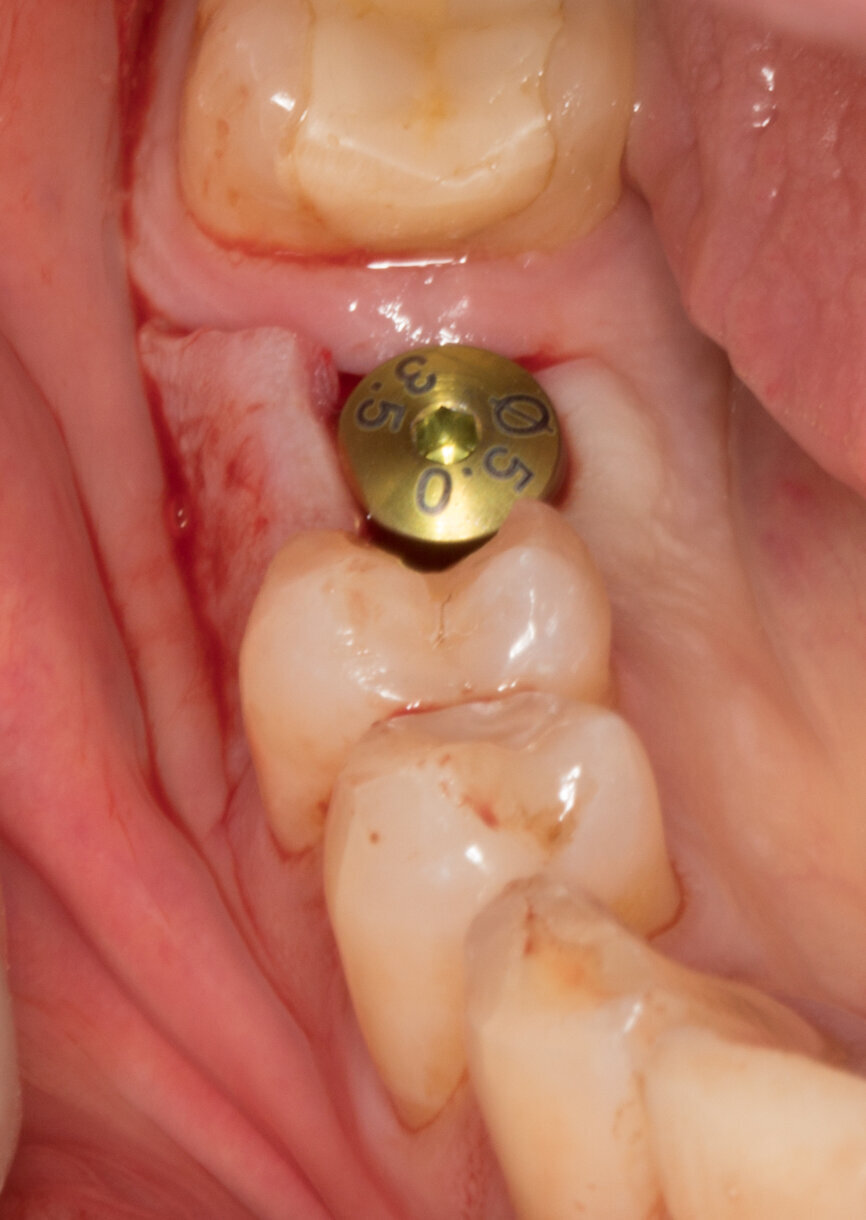 Ryc. 23-25_Dokręcona śruba gojąca na czas projektu i frezowania korony tymczasowej.