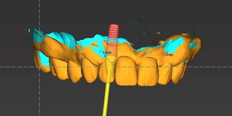 Fig. 12_Visione senza dima con l’inclinazione vestibolo-distale sul 1.2.