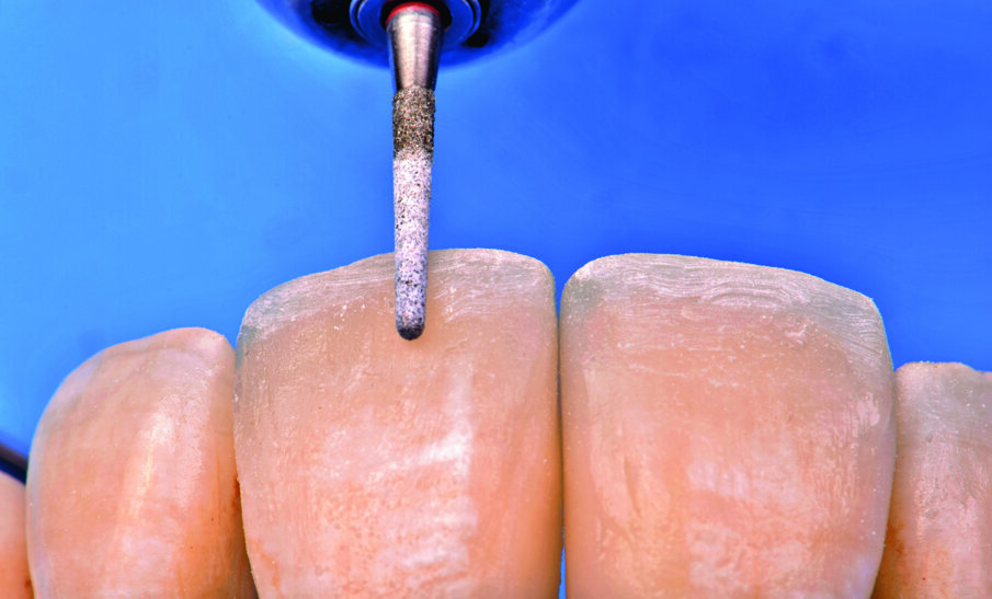 Fig 14. Gross finishing with Fine Diamond Point (Red Band on the shank) at very low speed with no water