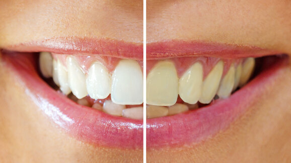 Neue SSO-Broschüre zum Thema Bleaching