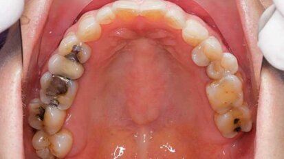 ¿Estamos preparados para la erradicación de la amalgama?