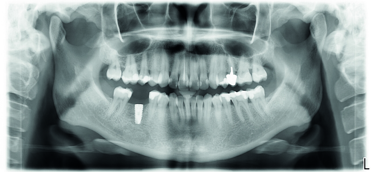 Fig. 13 : Radio panoramique de contrôle postopératoire.