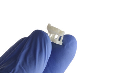 3D printing of an inlay and overlay using SprintRay’s Ceramic Crown resin: A case report