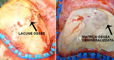 Gestione delle complicanze nella chirurgia  cranio-facciale