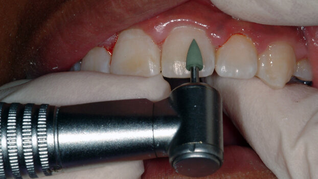 Polishing up your orthodontic finish