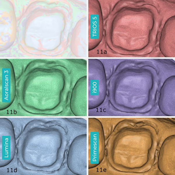 Figs. 11a–e: Close-up images of the tooth preparation scans and their tessellated meshes. TRIOS 5 (a). Aoralscan 3 (b). Medit i900 (c). ITero Lumina (d). CEREC Primescan (e).