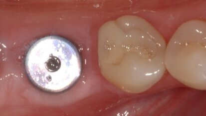 Αποζημίωση μαμούθ για λάθος εμφύτευμα