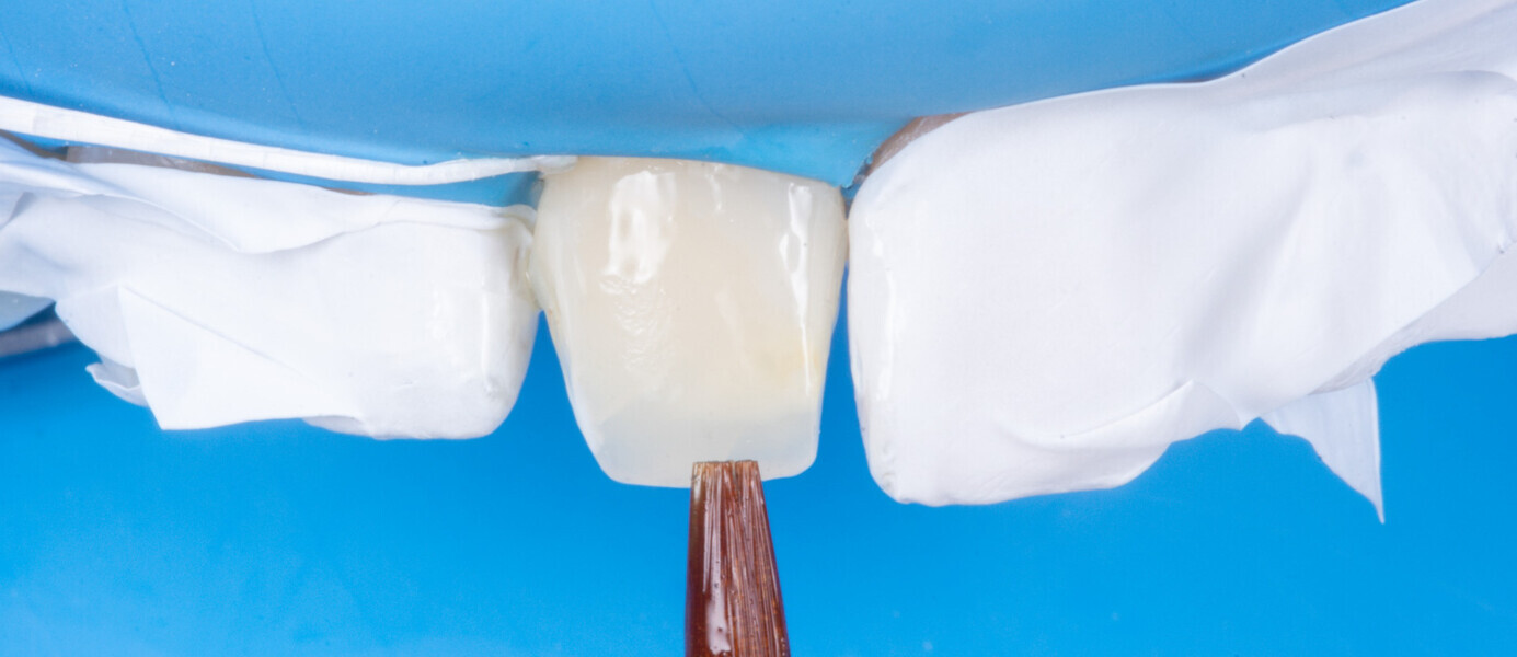 Fig. 17 : Application du système adhésif (Clearfil SE BOND).