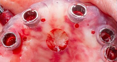 Arcate superiore e inferiore riabilitate con Chirurgia Guidata Simultanea full arch