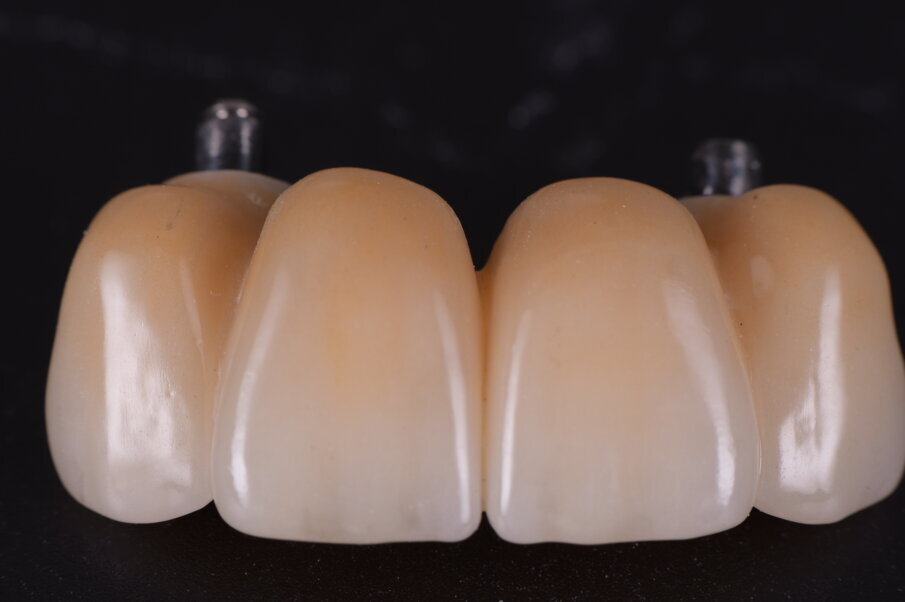 Fig. 44_Il momento della consegna rappresenta anche un controllo che deve valutare la cementazione dei monconi l’eventuale presenza di eccessi di cemento, la lucidatura dei punti di contatto e degli spazi interpapillari.