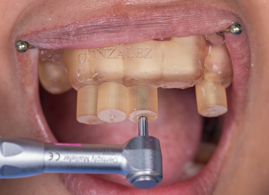 Fig. 1a: Static navigation stent used for endodontic access cavity preparations. The pre-planned stent does not allow for reorientation of the drill during the preparation. This can be consequential in accessing calcified, sclerosed canals. (Courtesy of Dr Paula Villa)