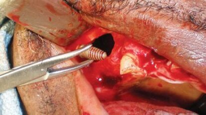 Implants migrés dans le sinus maxillaire