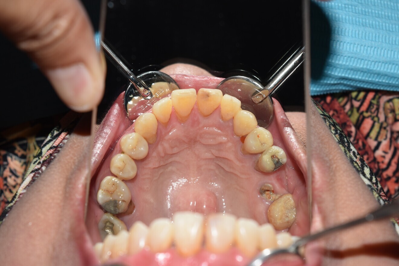  Fig. 5c: Brackets just removed. Before  bridge preparation.