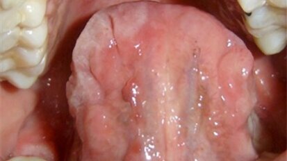 Prevalencia de manifestaciones orales de sífilis en un hospital Salta