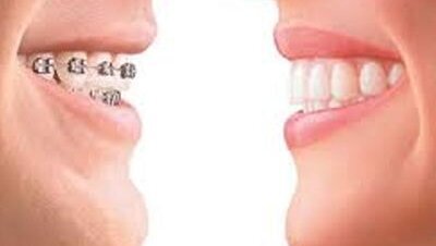 Σταυροειδής σύγκλειση