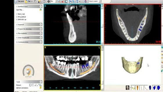 Materialise Dental et Zimmer Dental établissent un partenariat