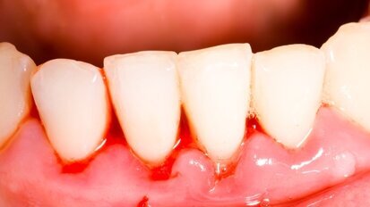 Diyabet Diş Etini Vuruyor