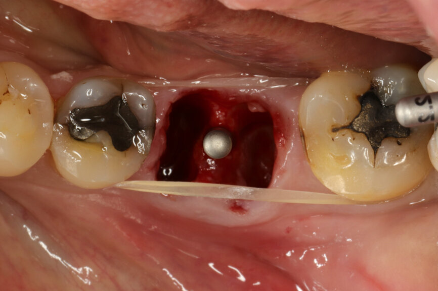 Fig. 9: Alignment of the ⌀ 2.2 mm drill, confirming 3D position.