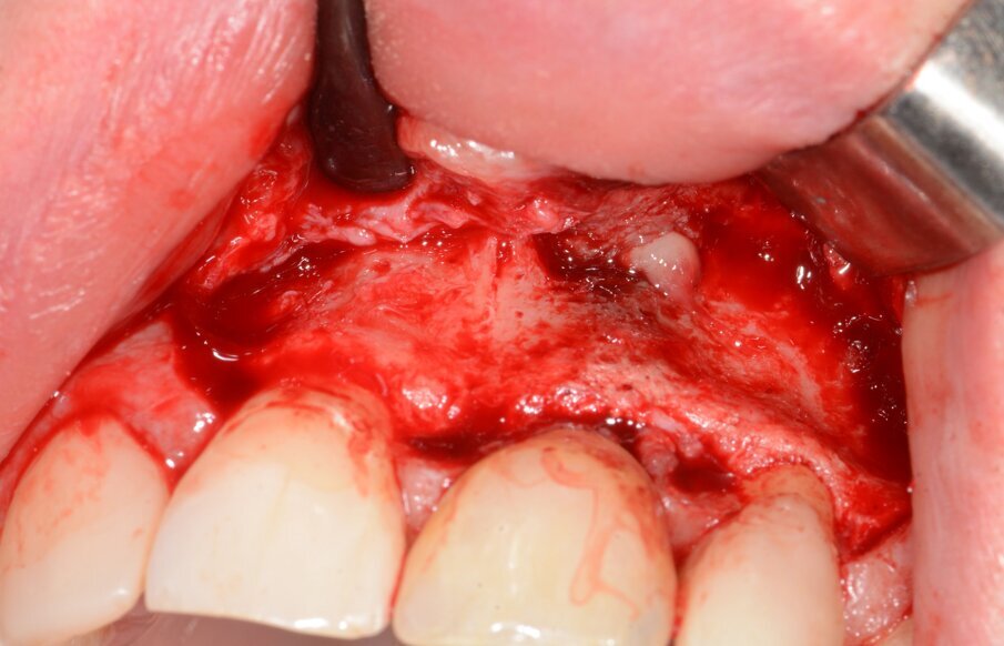 Fig. 15: Flap elevation.