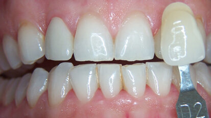 Lo sbiancamento come terapia cosmetica “strumentale”