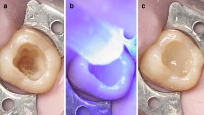 Restauración clase I con composite termoviscoso