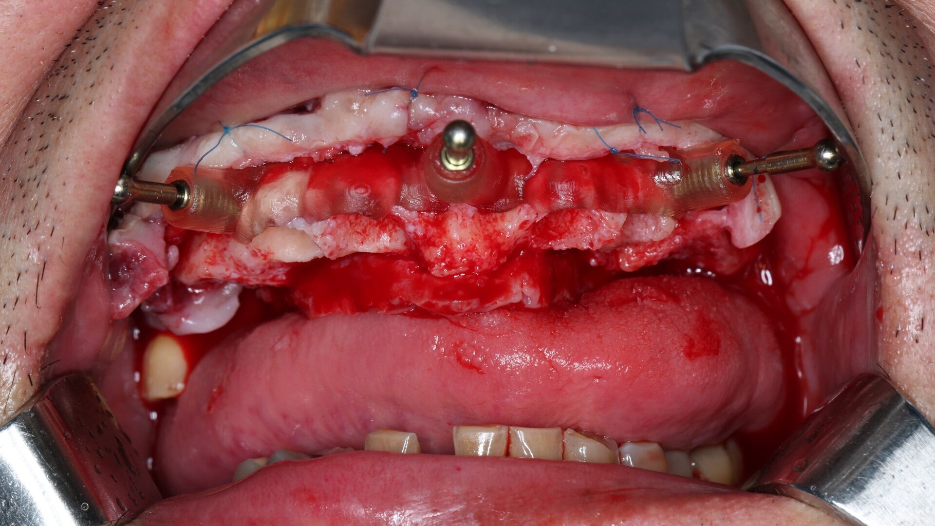 Compromised maxillary dentition treated with Straumann Pro Arch and a digital workflow