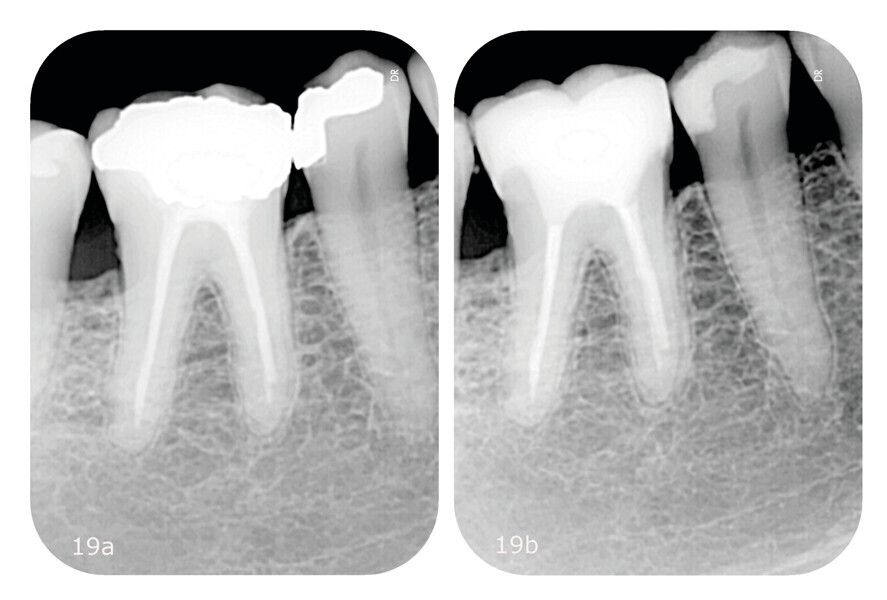 Figs. 19a & b: Comparison of the pre- and post-treatment radiographs. Initial periapical radiograph characterised by an overcontoured dental filling in tooth #45 and endodontic underfilling in tooth #46 (a). Final periapical radiograph confirming the good adaptation of both restorations (b).