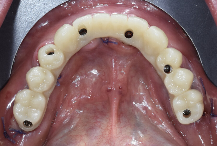 Fig. 22 - Visione occlusale carico immediato.