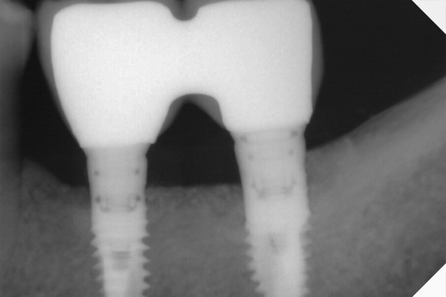 Fig. 12 - Controllo radiografico a 15 mesi, i livelli perimplantari sono mantenuti.