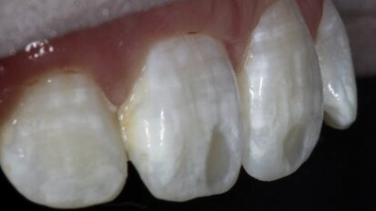 Leczenie białych plam na powierzchniach wargowych zębów – opis przypadku