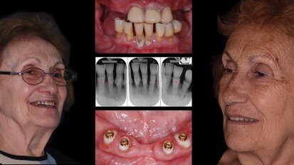 Colocación de sobredentadura sobre raíz natural del diente en paciente edéntulo Colocación de sobredentadura sobre raíz natural del diente en paciente edéntulo