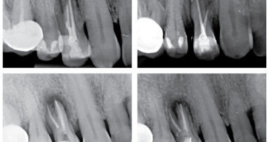 Když se příroda vysmívá endodontistům – dvě kazuistiky