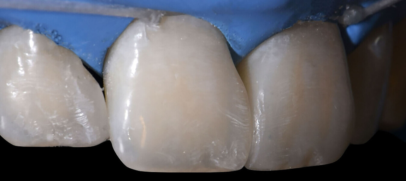 Fig. 15a: Control of restoration.