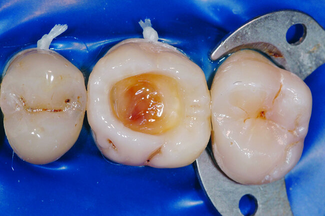 Fig. 22: Après polymérisation, les surfaces dentaires apparaissent lisses et brillantes objectivant une application uniforme et homogène de système adhésif. 