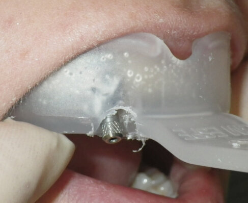 Fig. 5: The 3M™ Directed Flow Impression Tray is being tried in the mouth to make sure that the impression screw is accessible.