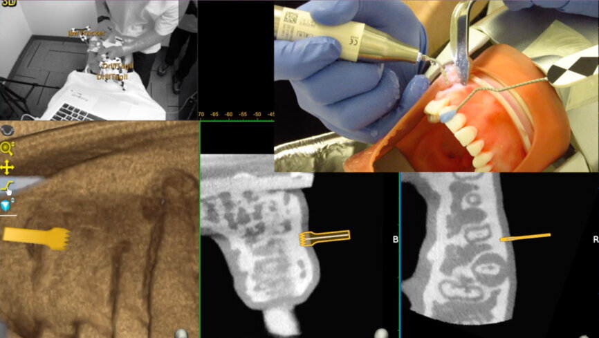 Fig. 4c: Piezotome planning. (Courtesy of Dr Bobby Nadeau)
